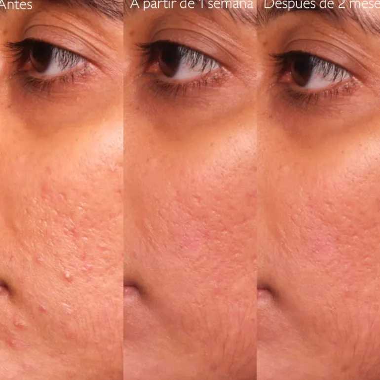 Vinopure Sérum con Acido Salicílico Anti-imperfecciones